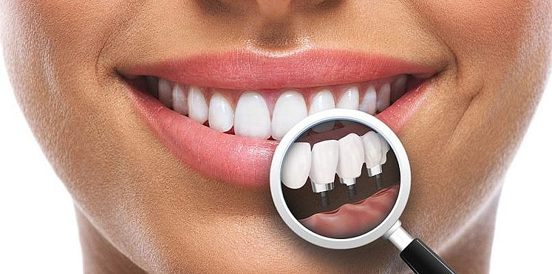 Implanturile Dentare Sunt Usor De Ingrijit