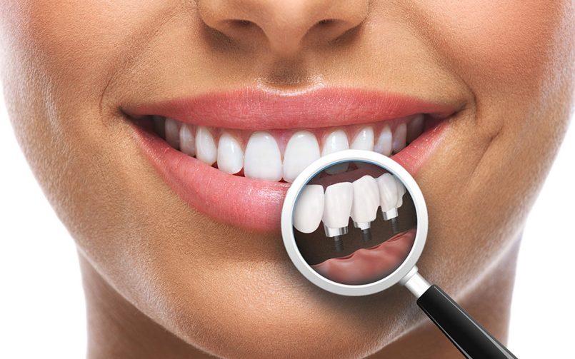 Ce avantaje au implanturile dentare?